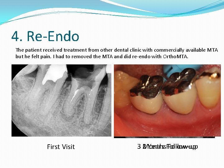 4. Re-Endo The patient received treatment from other dental clinic with commercially available MTA