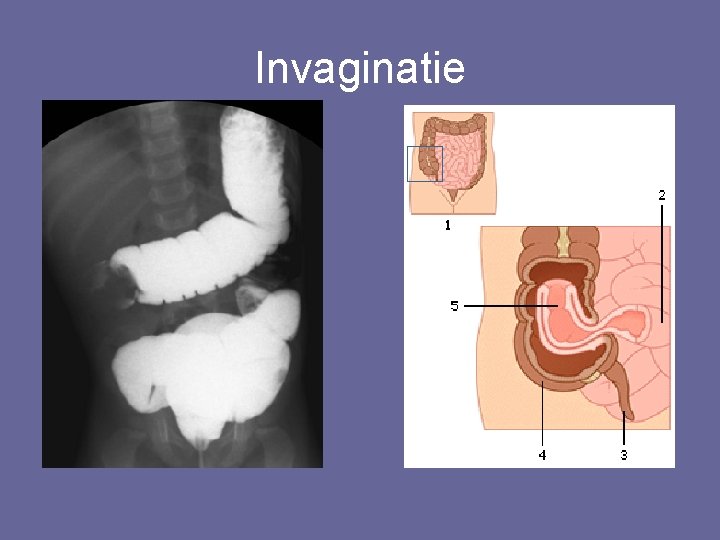 Invaginatie 