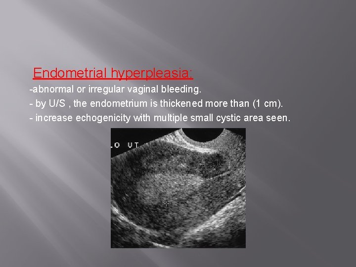 Endometrial hyperpleasia: -abnormal or irregular vaginal bleeding. - by U/S , the endometrium is