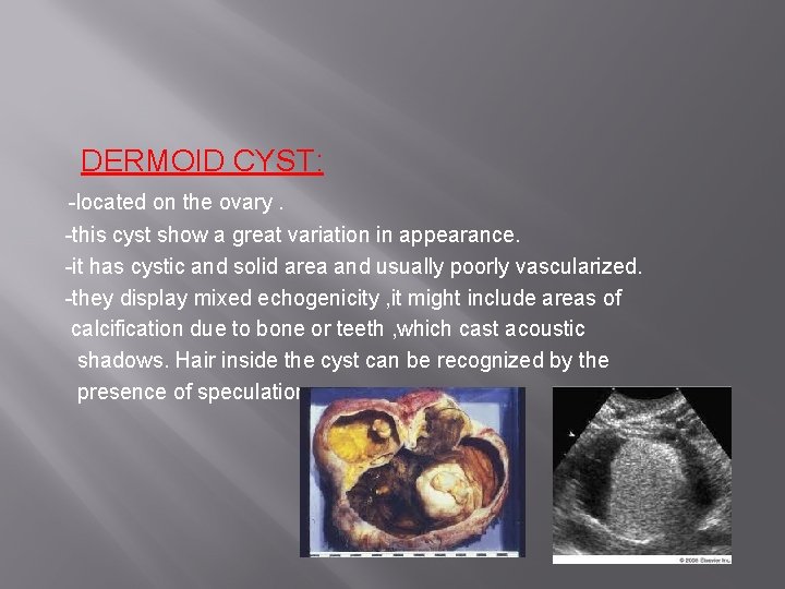 DERMOID CYST: -located on the ovary. -this cyst show a great variation in appearance.