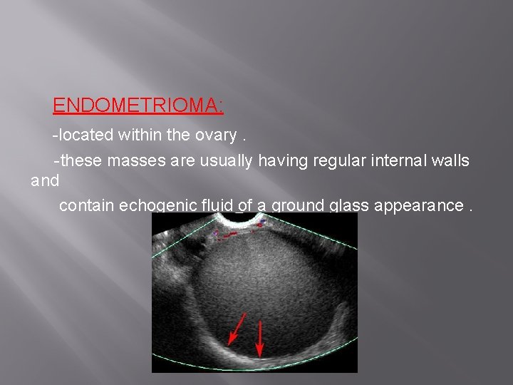 ENDOMETRIOMA: -located within the ovary. -these masses are usually having regular internal walls and