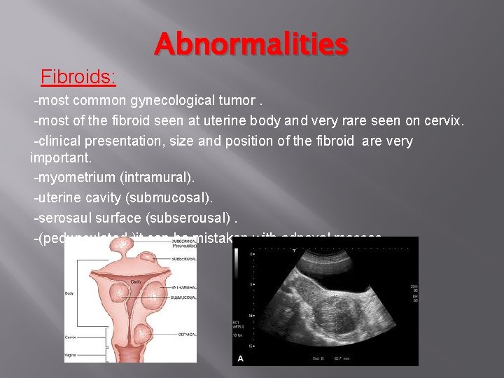 Fibroids: Abnormalities -most common gynecological tumor. -most of the fibroid seen at uterine body