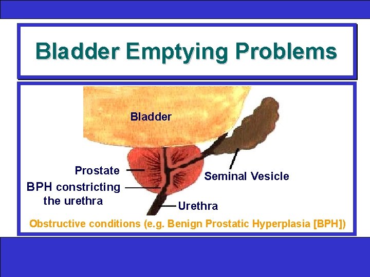 Bladder Emptying Problems Bladder Prostate BPH constricting the urethra Seminal Vesicle Urethra Obstructive conditions
