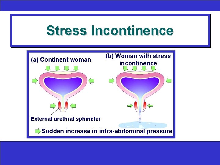 Stress Incontinence (a) Continent woman (b) Woman with stress incontinence External urethral sphincter Sudden
