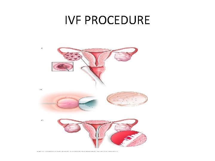 IVF PROCEDURE IVF PROCEDURE