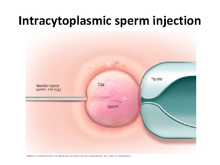 Intracytoplasmic sperm injection Intracytoplasmic sperm injection