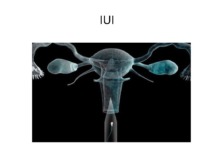 IUI IUI