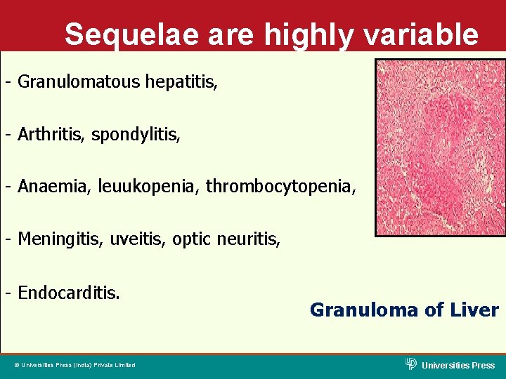 Sequelae are highly variable - Granulomatous hepatitis, - Arthritis, spondylitis, - Anaemia, leuukopenia, thrombocytopenia,