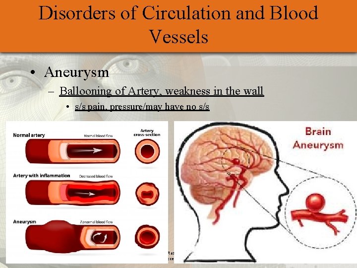 Disorders of Circulation and Blood Vessels • Aneurysm – Ballooning of Artery, weakness in
