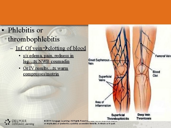  • Phlebitis or thrombophlebitis – Inf. Of vein clotting of blood • s/s