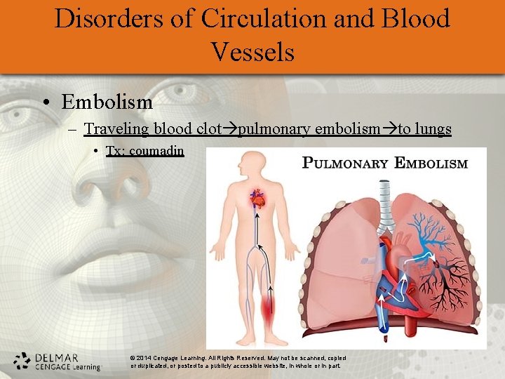 Disorders of Circulation and Blood Vessels • Embolism – Traveling blood clot pulmonary embolism