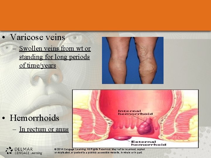  • Varicose veins – Swollen veins from wt or standing for long periods