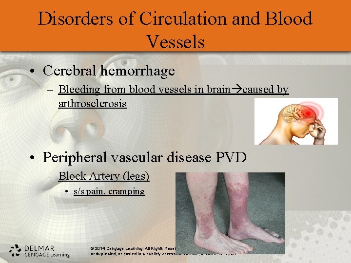 Disorders of Circulation and Blood Vessels • Cerebral hemorrhage – Bleeding from blood vessels