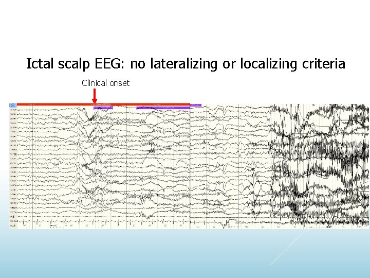 Ictal scalp EEG: no lateralizing or localizing criteria Clinical onset 