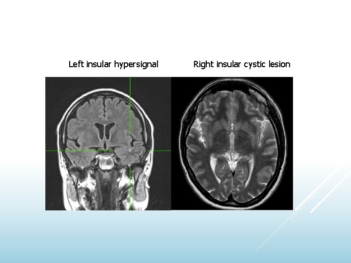 Left insular hypersignal Right insular cystic lesion 