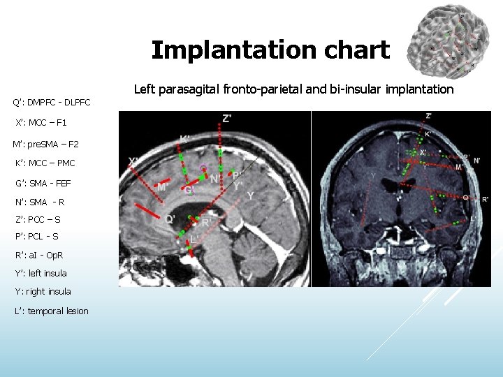 Implantation chart Left parasagital fronto-parietal and bi-insular implantation Q’: DMPFC - DLPFC X’: MCC