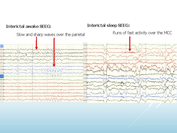 Interictal awake SEEG: Slow and sharp waves over the parietal Interictal sleep SEEG: Runs