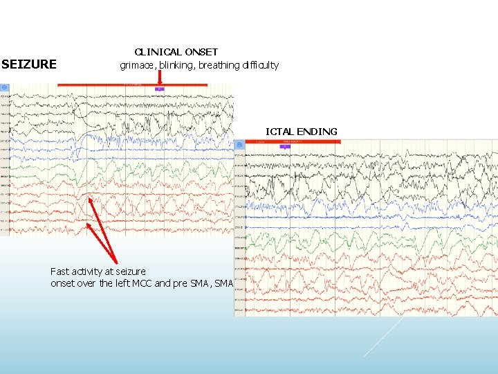 SEIZURE CLINICAL ONSET grimace, blinking, breathing difficulty ICTAL ENDING Fast activity at seizure onset