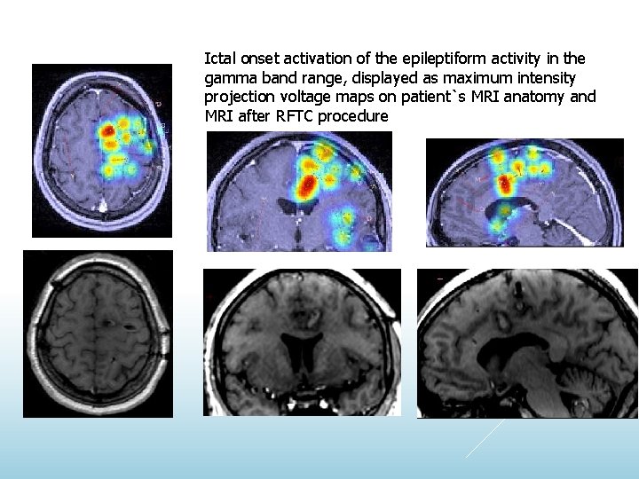 Ictal onset activation of the epileptiform activity in the gamma band range, displayed as