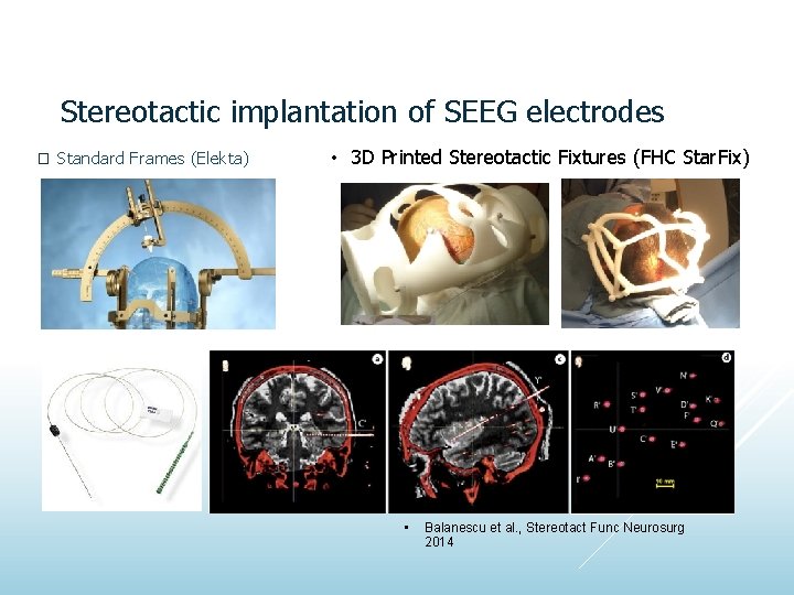 Stereotactic implantation of SEEG electrodes � Standard Frames (Elekta) • 3 D Printed Stereotactic