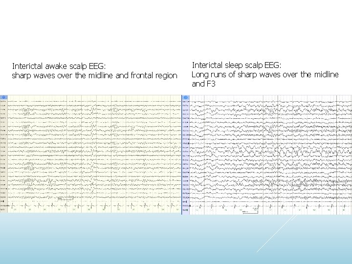 Interictal awake scalp EEG: sharp waves over the midline and frontal region Interictal sleep