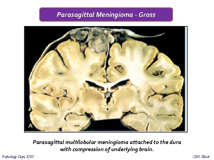 Parasagittal Meningioma - Gross Parasagittal multilobular meningioma attached to the dura with compression of