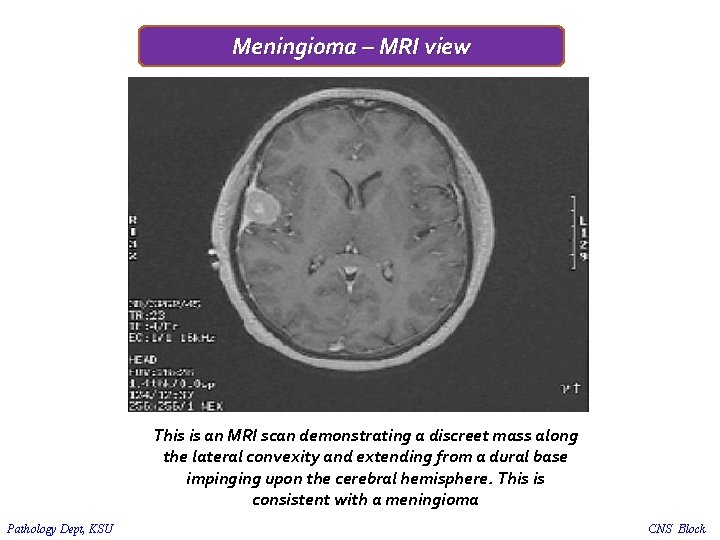 Meningioma – MRI view This is an MRI scan demonstrating a discreet mass along