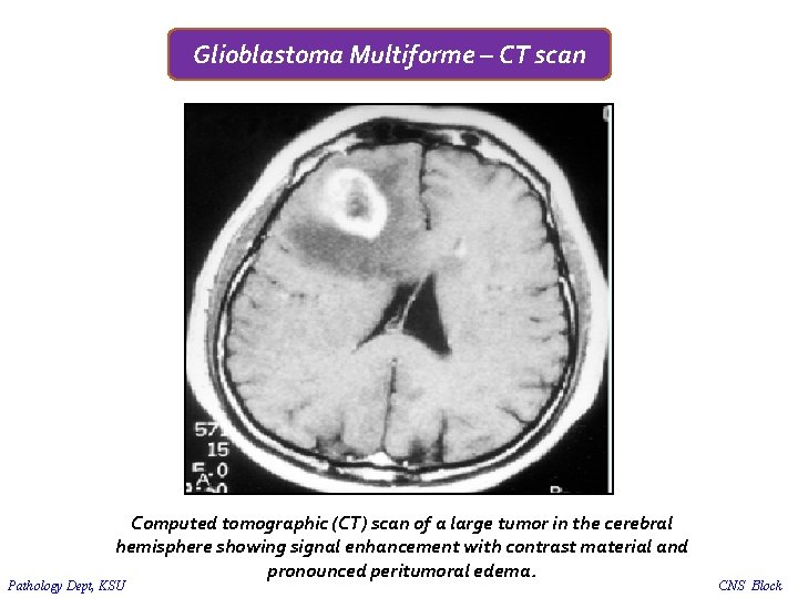 Glioblastoma Multiforme – CT scan Computed tomographic (CT) scan of a large tumor in