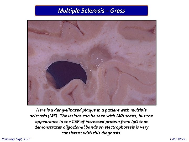 Multiple Sclerosis – Gross Here is a demyelinated plaque in a patient with multiple