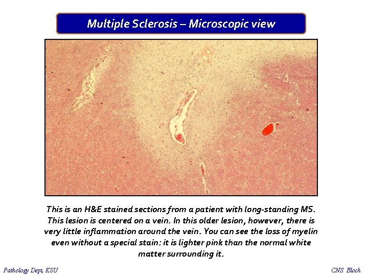 Multiple Sclerosis – Microscopic view This is an H&E stained sections from a patient