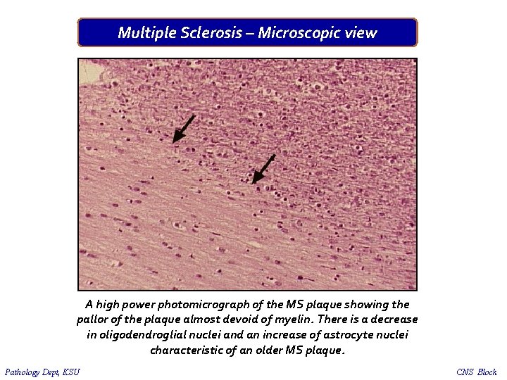 Multiple Sclerosis – Microscopic view A high power photomicrograph of the MS plaque showing