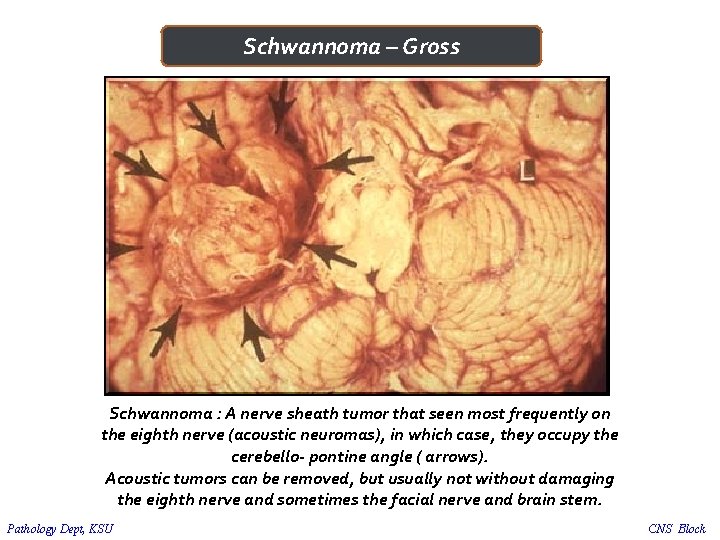 Schwannoma – Gross Schwannoma : A nerve sheath tumor that seen most frequently on