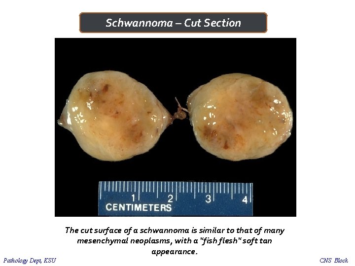 Schwannoma – Cut Section The cut surface of a schwannoma is similar to that