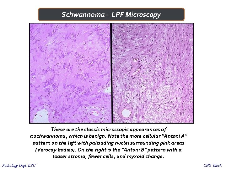 Schwannoma – LPF Microscopy These are the classic microscopic appearances of a schwannoma, which