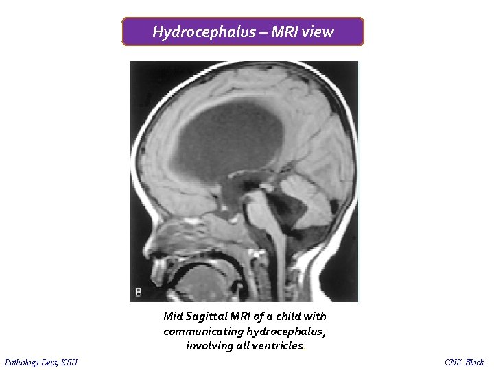 Hydrocephalus – MRI view Mid Sagittal MRI of a child with communicating hydrocephalus, involving