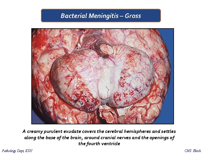 Bacterial Meningitis – Gross A creamy purulent exudate covers the cerebral hemispheres and settles
