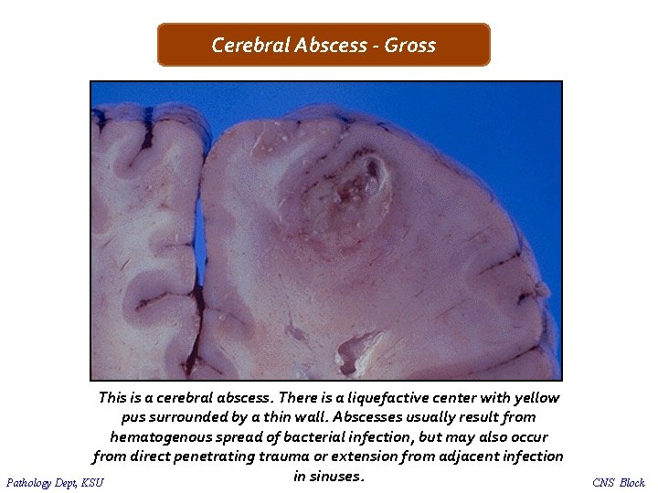 Cerebral Abscess - Gross This is a cerebral abscess. There is a liquefactive center