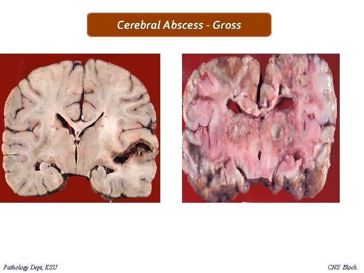 Cerebral Abscess - Gross Pathology Dept, KSU CNS Block 