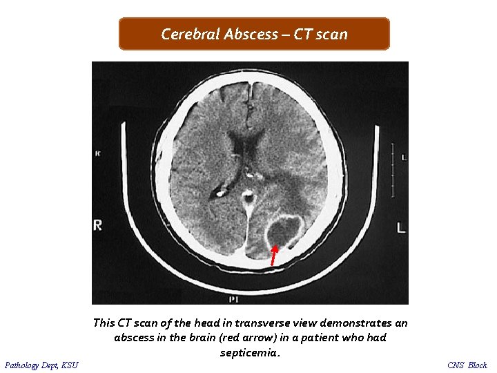 Cerebral Abscess – CT scan This CT scan of the head in transverse view