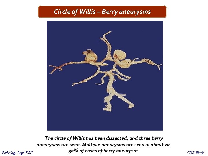 Circle of Willis – Berry aneurysms Pathology Dept, KSU The circle of Willis has