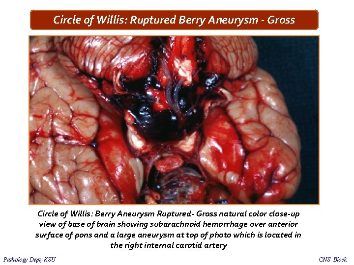 Circle of Willis: Ruptured Berry Aneurysm - Gross Circle of Willis: Berry Aneurysm Ruptured-