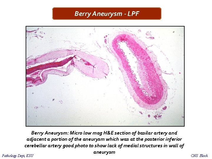 Berry Aneurysm - LPF Berry Aneurysm: Micro low mag H&E section of basilar artery