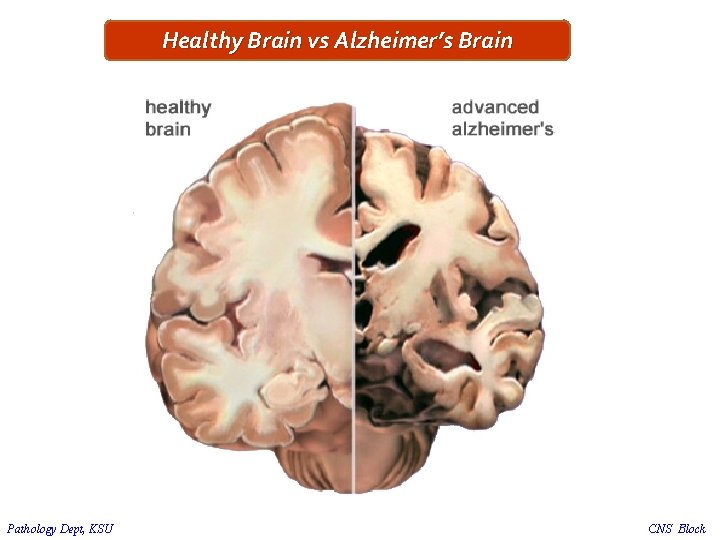 Healthy Brain vs Alzheimer’s Brain Pathology Dept, KSU CNS Block 