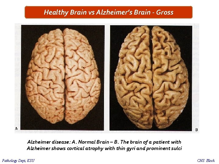 Healthy Brain vs Alzheimer’s Brain - Gross Alzheimer disease: A. Normal Brain – B.