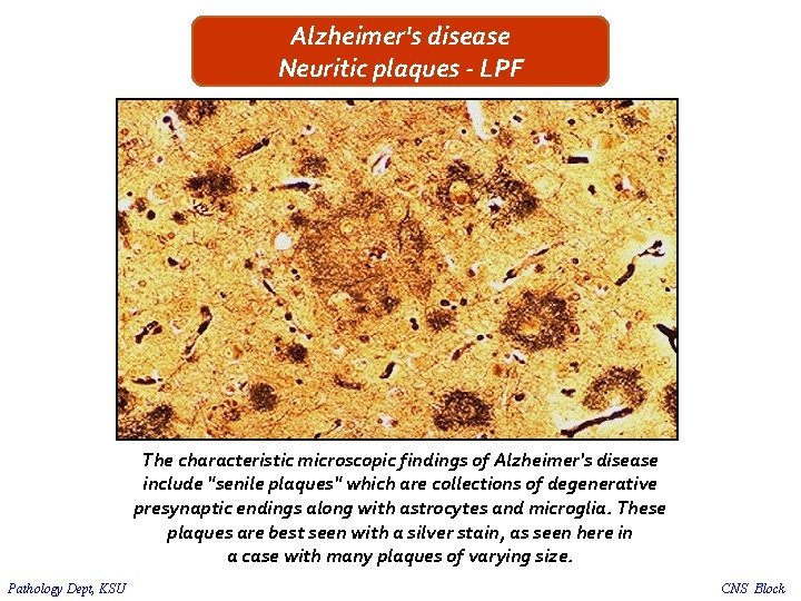 Alzheimer's disease Neuritic plaques - LPF The characteristic microscopic findings of Alzheimer's disease include