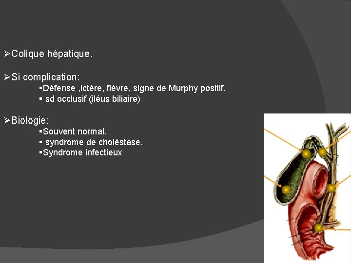 ØColique hépatique. ØSi complication: §Défense , ictère, fièvre, signe de Murphy positif. § sd