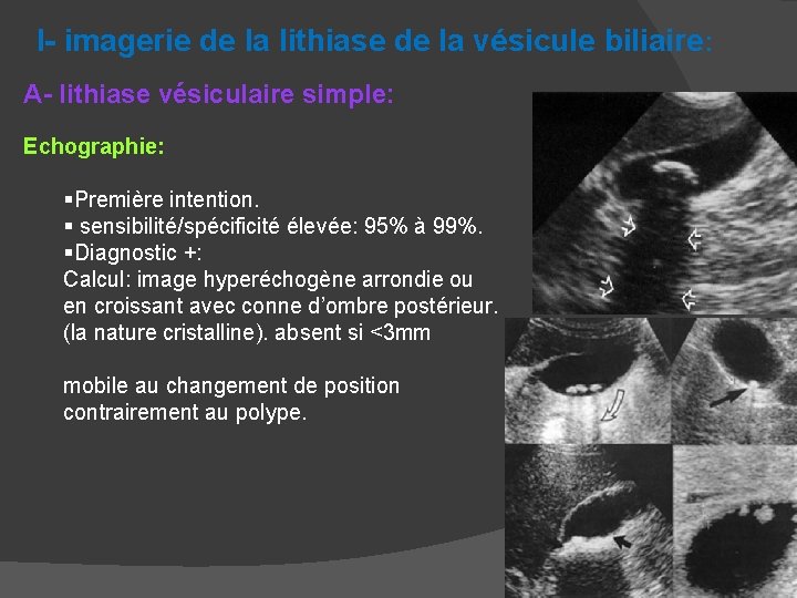 I- imagerie de la lithiase de la vésicule biliaire: A- lithiase vésiculaire simple: Echographie: