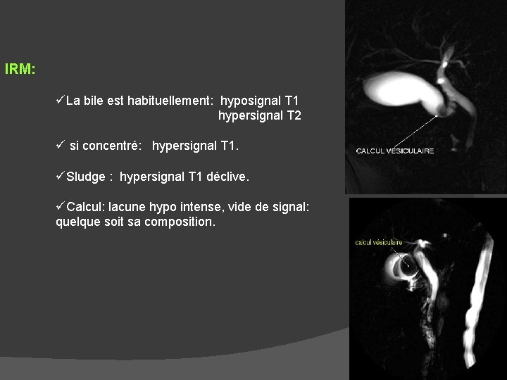 IRM: üLa bile est habituellement: hyposignal T 1 hypersignal T 2 ü si concentré: