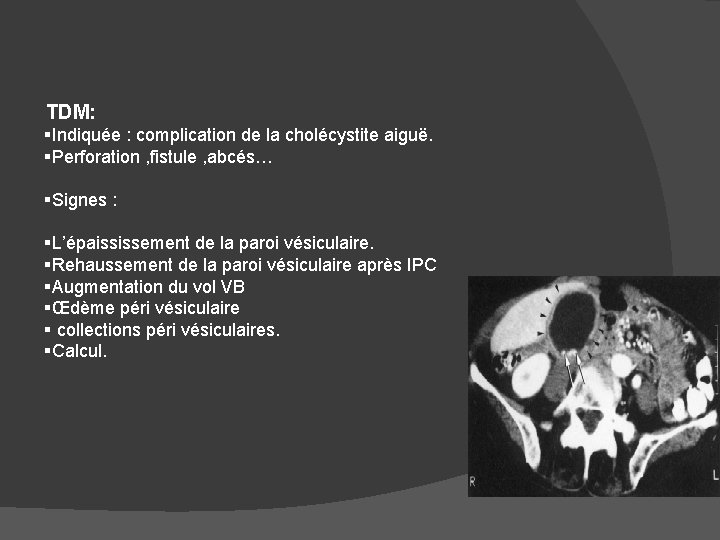 TDM: §Indiquée : complication de la cholécystite aiguë. §Perforation , fistule , abcés… §Signes