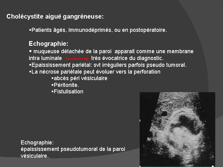 Cholécystite aiguë gangréneuse: §Patients âgés, immunodéprimés, ou en postopératoire. Echographie: § muqueuse détachée de